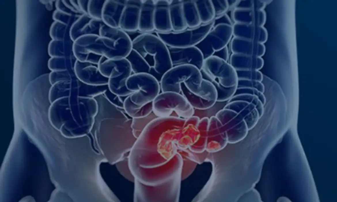 Rastreamento para câncer colorretal pode ser implementado no SUS